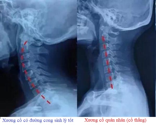 co_thang Hội chứng cổ quân nhân (cổ thẳng)