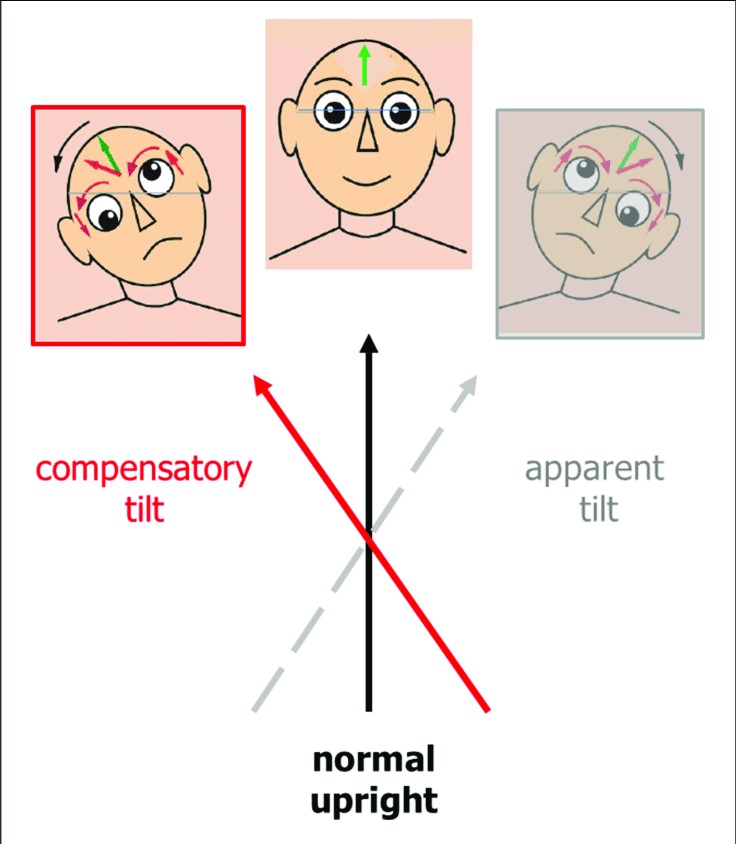 head Kiểm tra độ nghiên của mắt trẻ em để phát hiện cong vẹo cột sống
