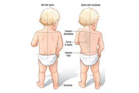 kid2-2 Cong vẹo cột sống ở trẻ em