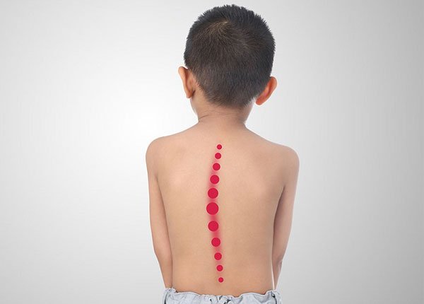 kid_scoliosis Cong vẹo cột sống trẻ em