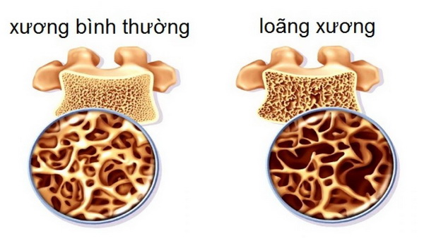 loang-xuong_resize Xương bình thường và loãng xương