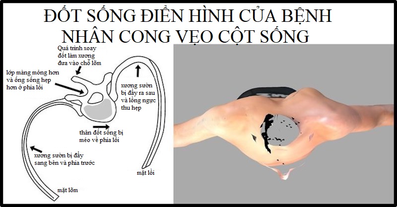rib-deformity-src-image Đốt sống ngực của bệnh nhân cong vẹo cột sống