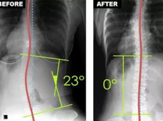 scoliosis-method-correction Scoliosis Correction Method
