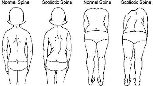 scoliosis_spine Cách nhận biết cong vẹo cột sống