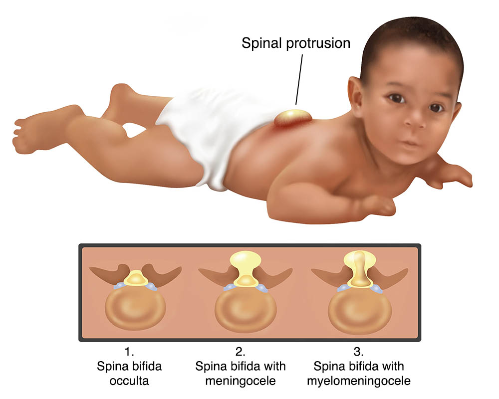 spina-bifida-24518e
