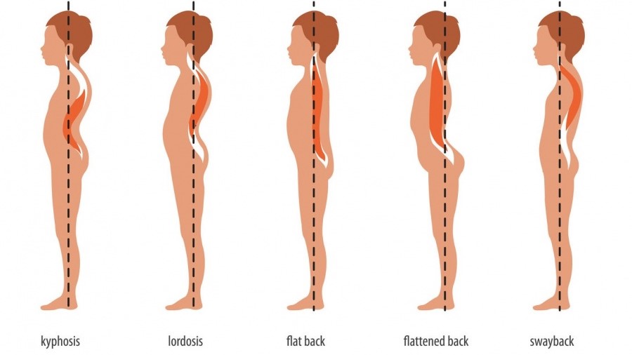 spine_disease Những biến dạng cột sống phổ biến