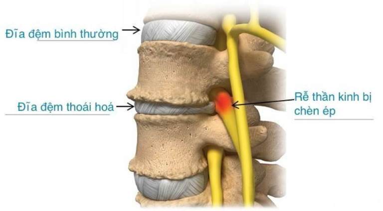 thoai-hoa-dia-dem Thoái hóa đĩa đệm